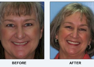 before after Advanced Dental Center