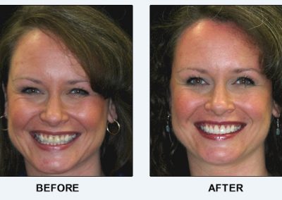 before after cosmetic dentistry