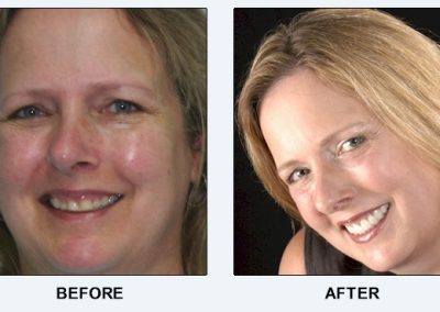 before after smile Advanced Dental Center