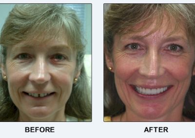 before after summerville dental