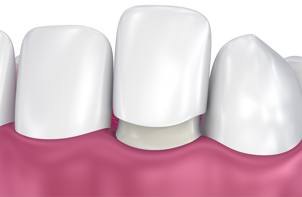 Dental Veneers SMILE! Advanced Dental Center