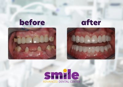 Smile Advanced Dental Center Before & After