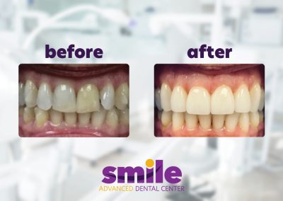 Smile Advanced Dental Center Before & After