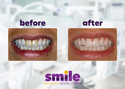 Smile Advanced Dental Center Before & After