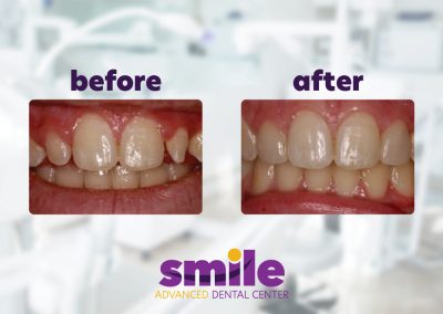 Smile Advanced Dental Center Before & After