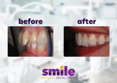 Smile Advanced Dental Center Before & After