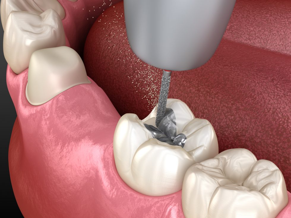 Understanding SMART and Safe Amalgam Removal SMILE! Advanced Dental Center Summerville