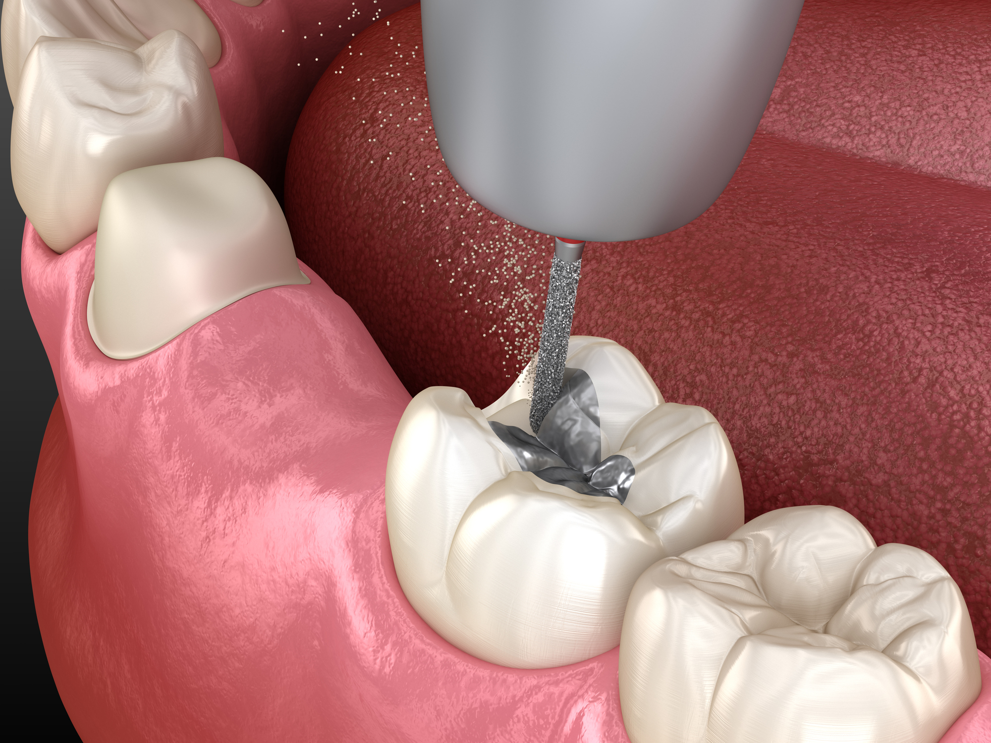 Amalgam removal