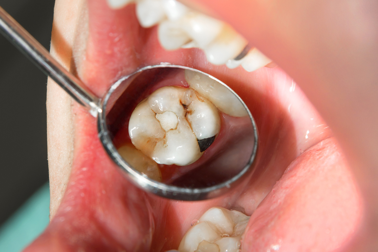 General Dentistry Crown vs Filling Feature