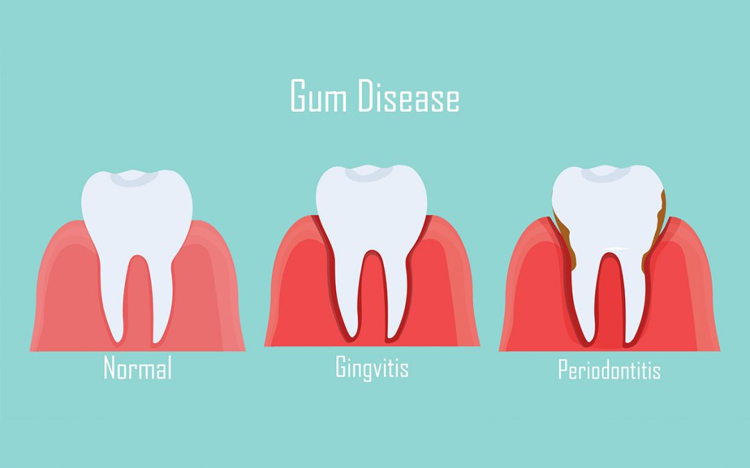 Why Do My Gums Bleed? Seven Causes and What Our General Dentistry Practice Recommends You Do Next