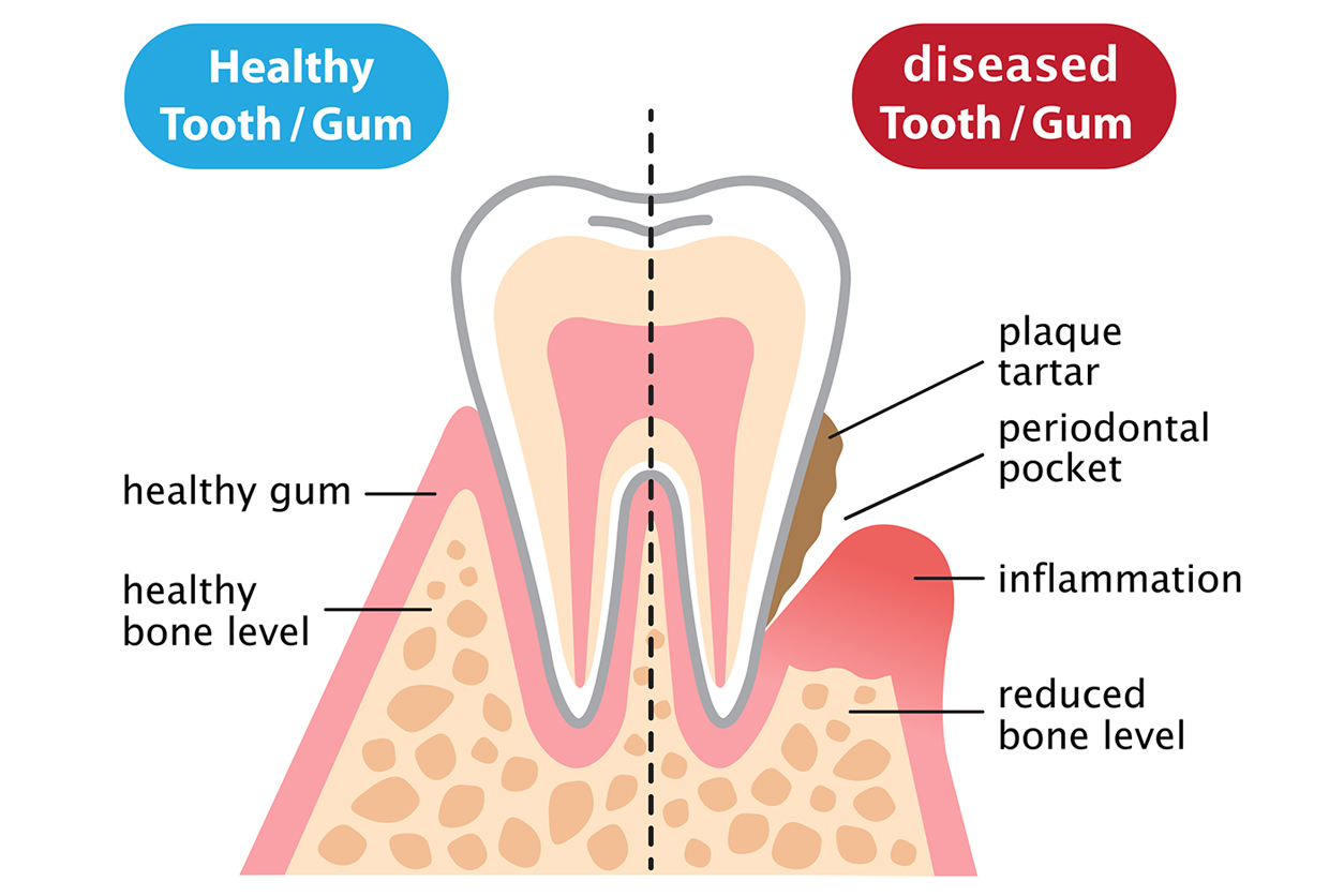 General Dentistry Crown vs Filling Feature