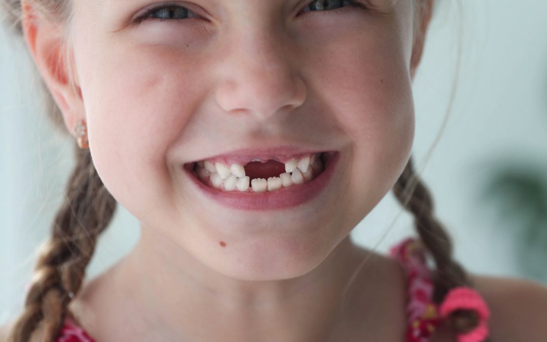 Mind The Gap: Options for Replacing a Missing Tooth