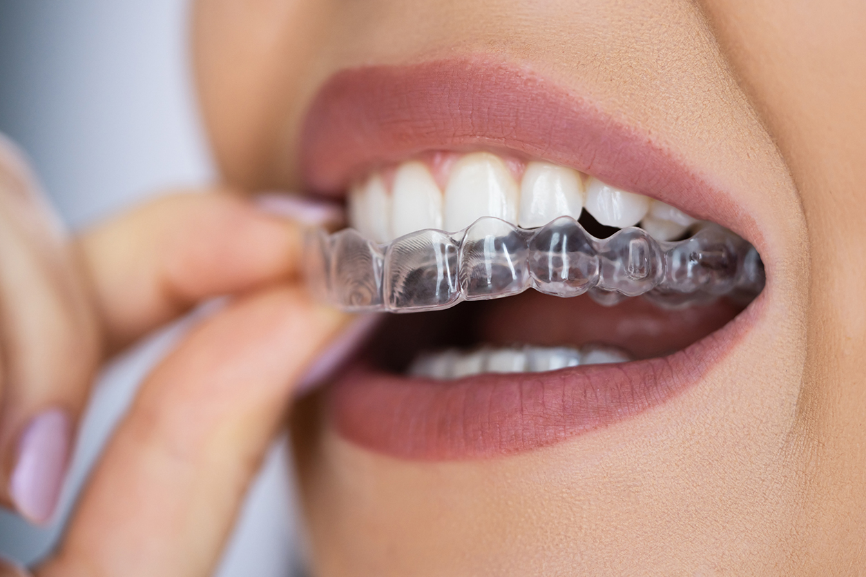 Retainers: The Invaluable Next Step