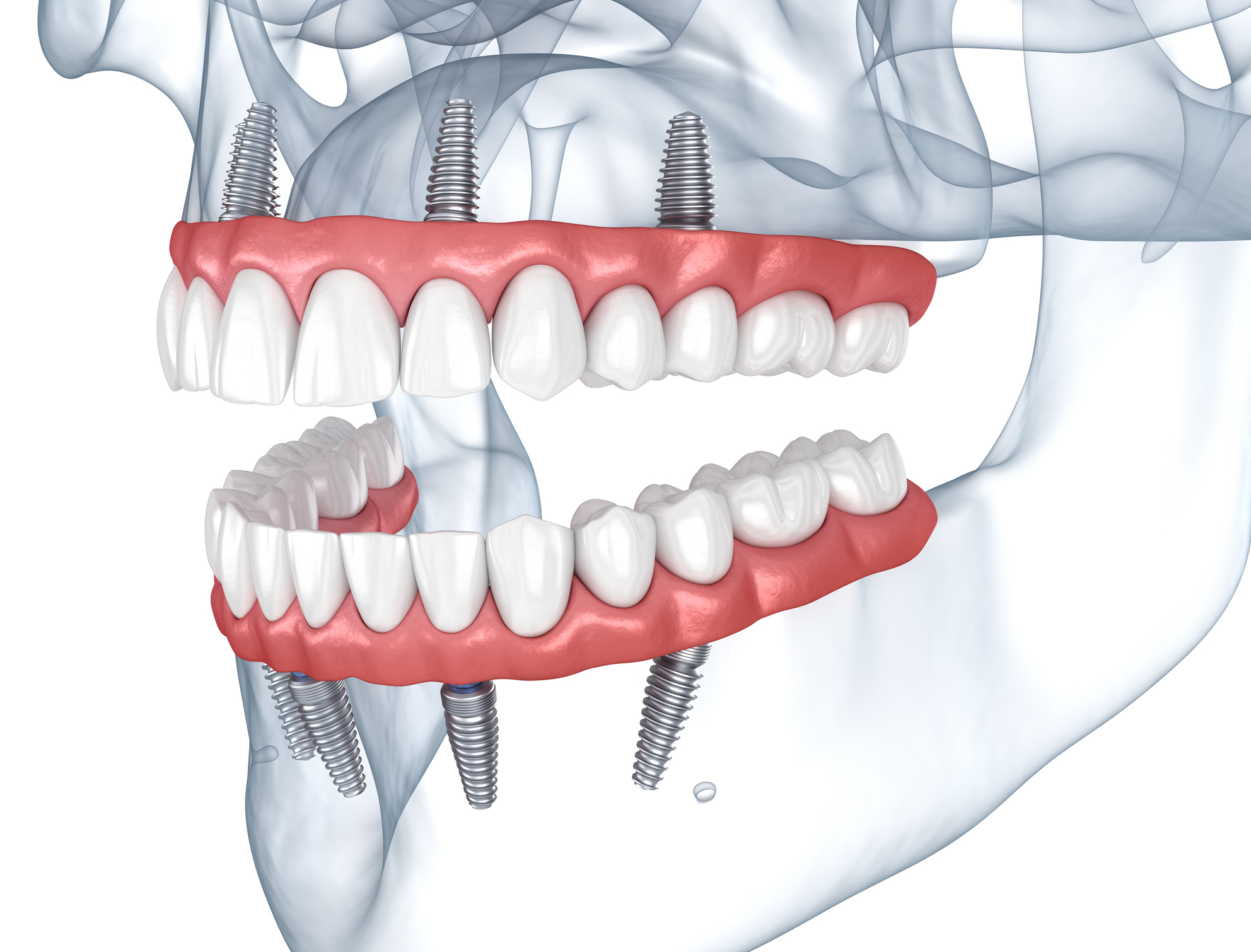 Prostheses supported by 8 implants. Dental 3D illustration