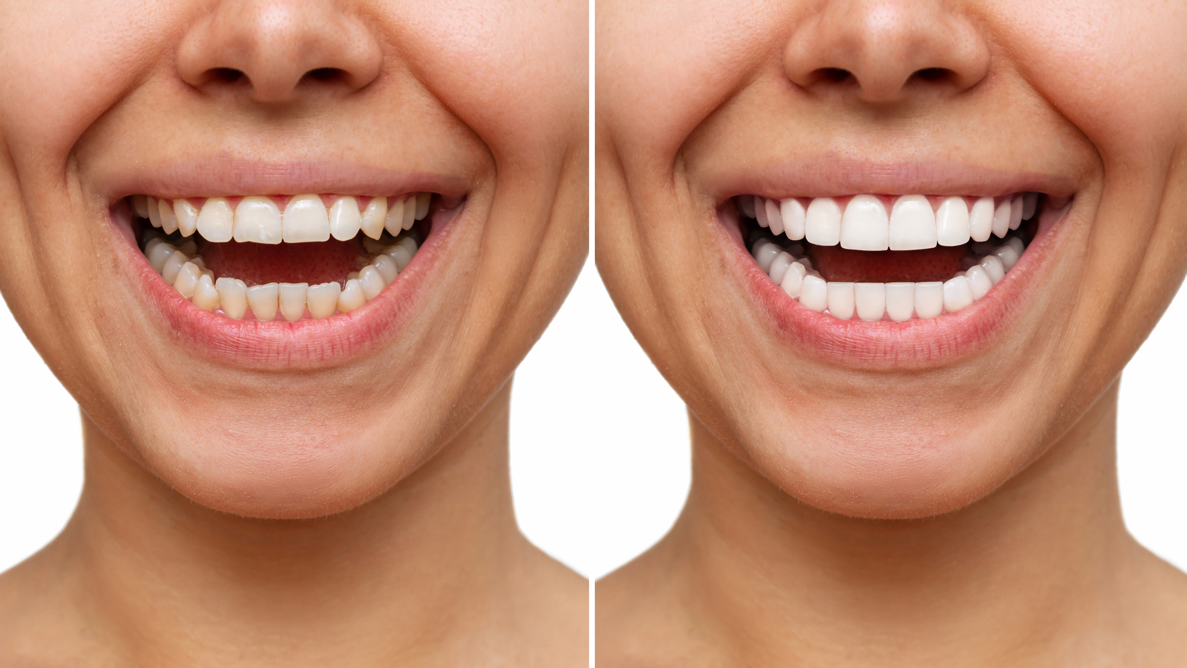 Unlocking a Radiant Smile: The Speedy Transformation Veneers Offer