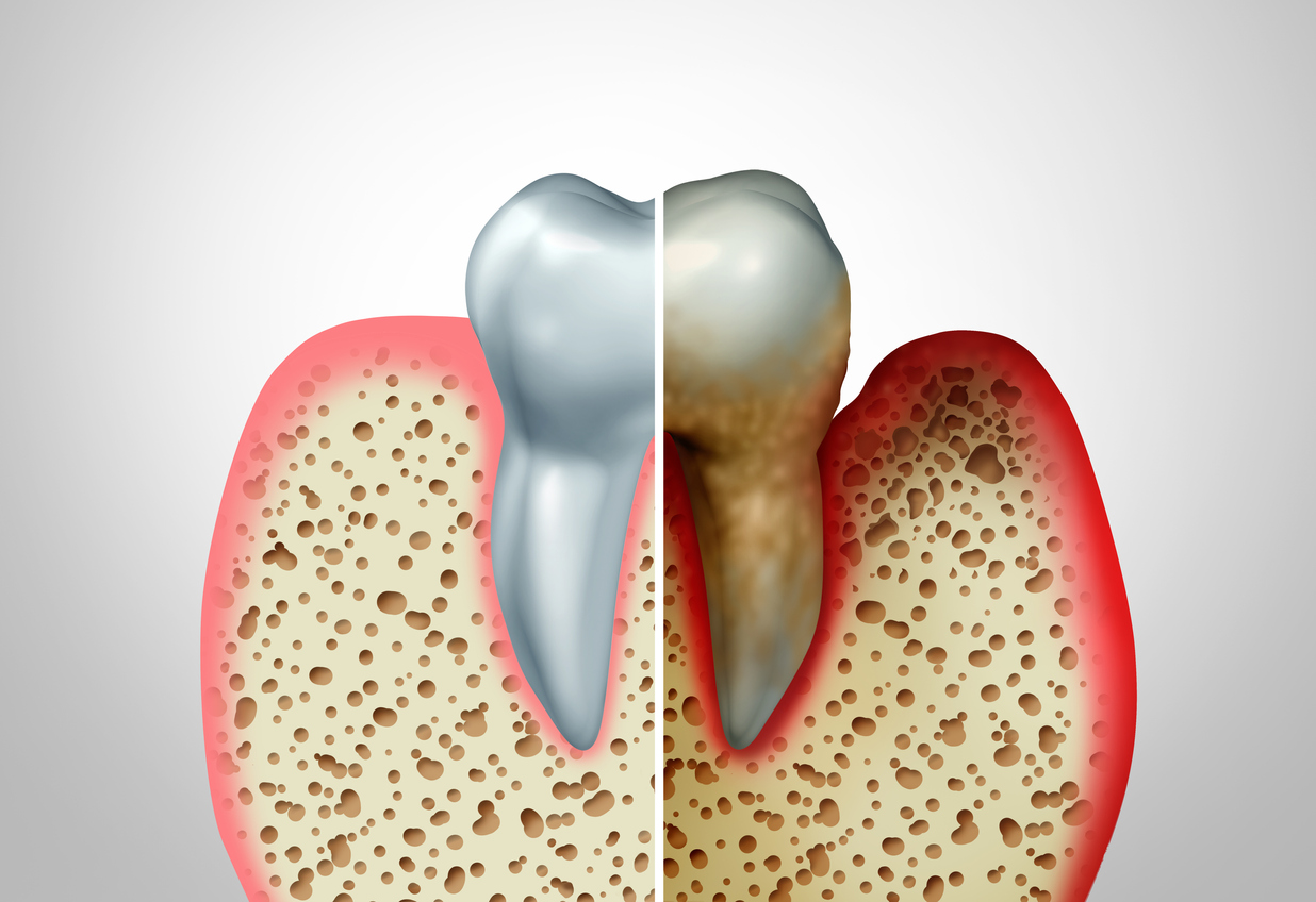 The Silent Menace: Guarding Your Smile Against Periodontal Disease